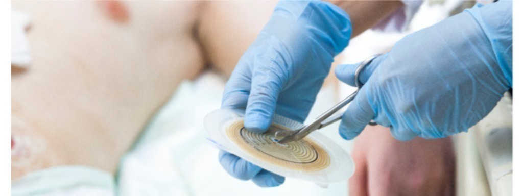 La gestione delle Stomie 