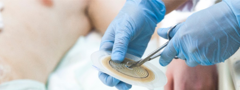 La gestione delle Stomie 